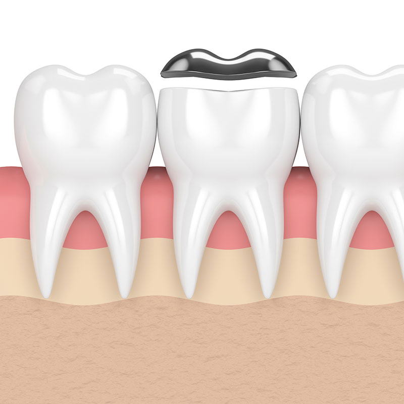 banner-inlays-onlays